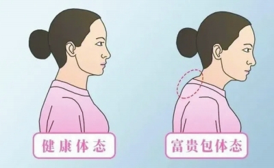 長期低頭玩手機？當心“富貴包”找上你